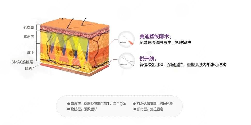 悦升线提升苹果肌效果怎么样?有这几点优势!面部紧致妙招~
