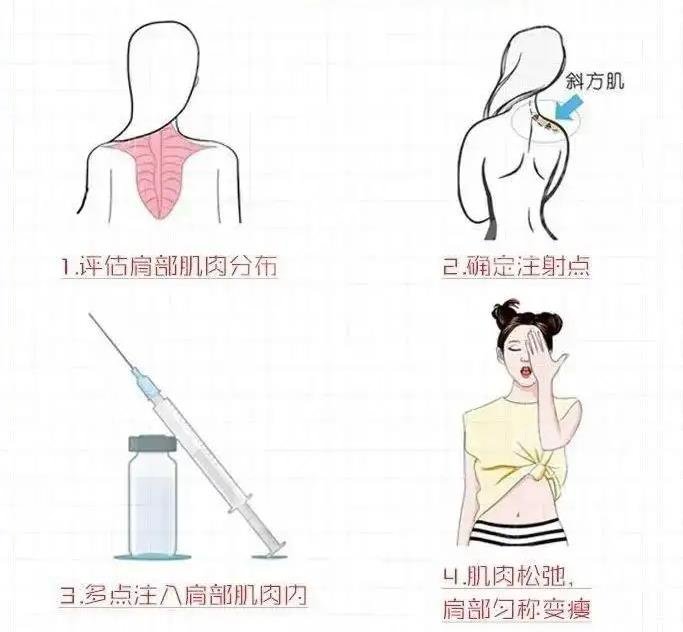 瘦肩针有什么危害和副作用