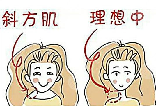 瘦肩针适应的人群都有哪些呢?