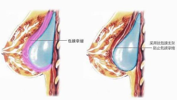 兔动感隆胸优势有哪些?