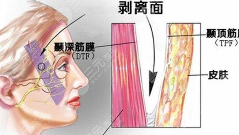 拉皮除皱