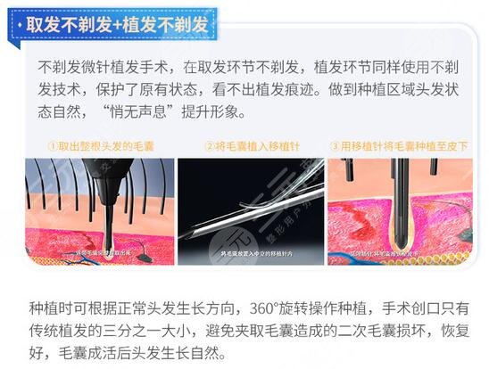 成都锦江大麦微针植发