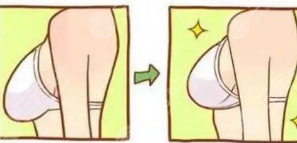 乳房悬吊提升手术的适应症有哪些?