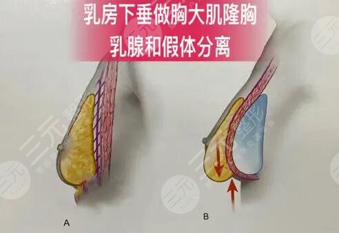 乳房悬吊提升手术风险大吗?
