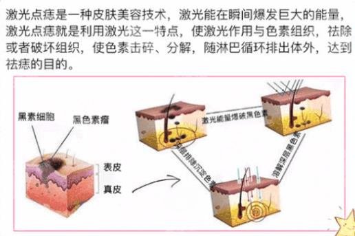 中山大学附属第一医院美容科祛痣案例分享|网友恢复心得