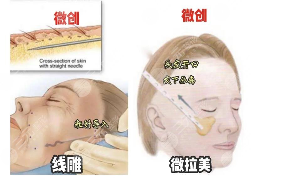微拉美能保持几年?
