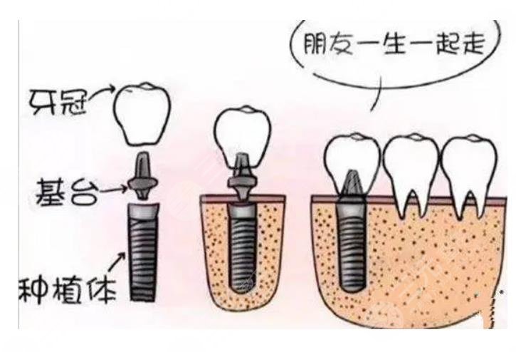 种植牙手术价格的影响因素