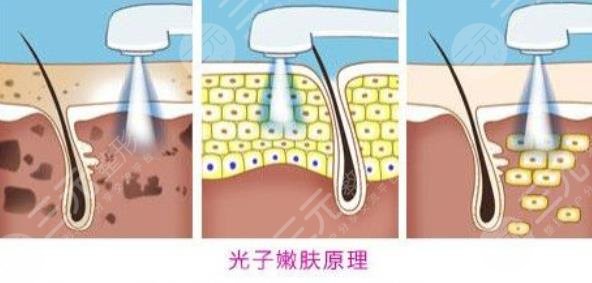 光子嫩肤原理