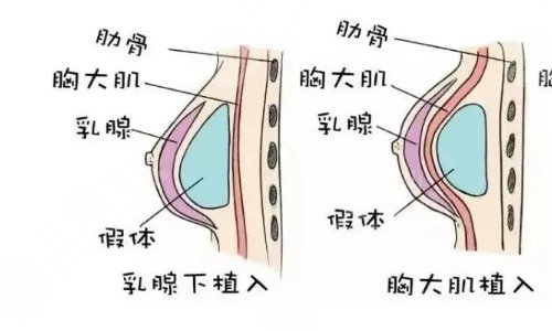 假体隆胸手术