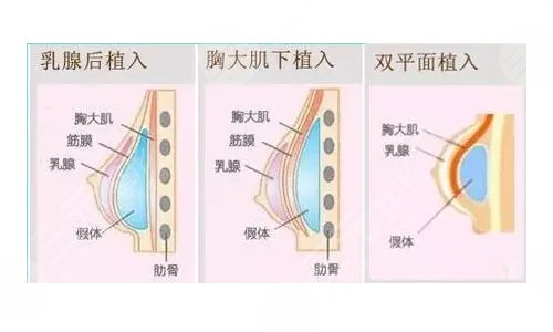 3D隆胸手之后应该注意什么?