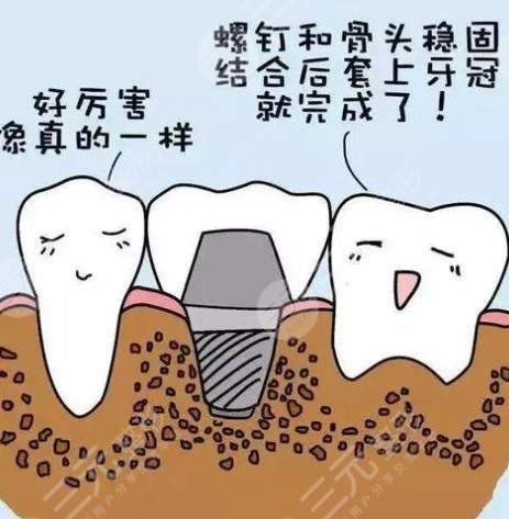 钦州市第二人民医院牙科种植牙案例