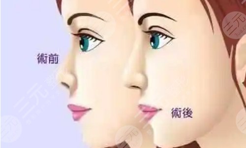 玻尿酸隆鼻的时候疼吗?