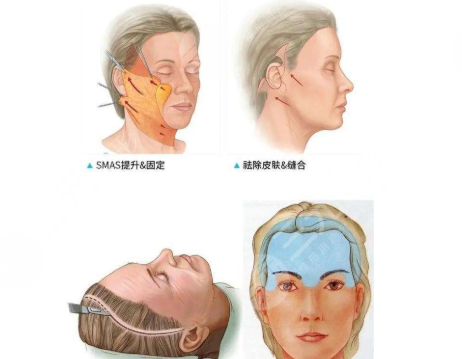 拉皮手术能维持几年?手术费多少钱?价格一览表+注意事项!