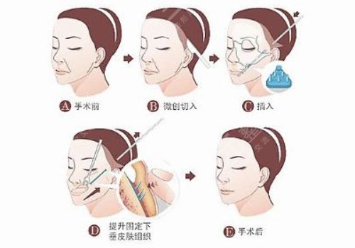 拉皮手术后如何护理
