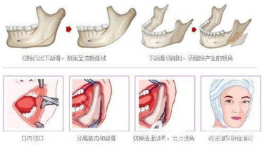 下颌角整形的手术是如何操作的?