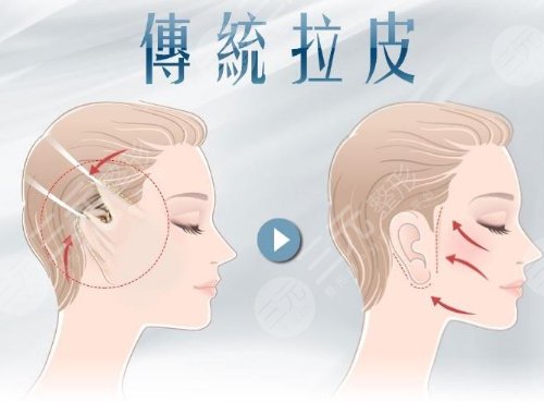 面部拉皮手术提升效果和视频