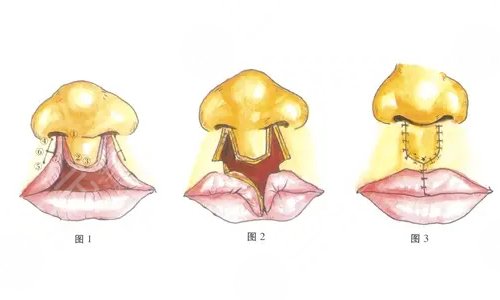 修复方式的选择