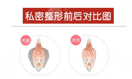 说欧洲之星私密点阵激光手术应该注意什么?