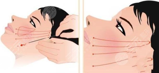 拉皮