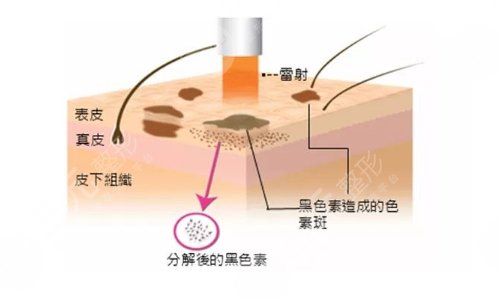 激光祛斑会反弹吗？该如何避免？原理、注意事项等盘点！