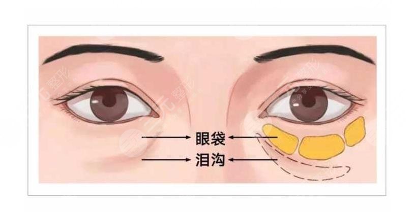 填充玻尿酸有哪些雷区呢?