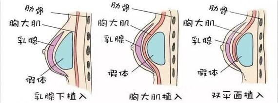 假体隆胸,深圳,医院