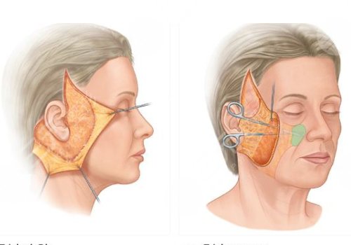 拉皮手术前要注意什么