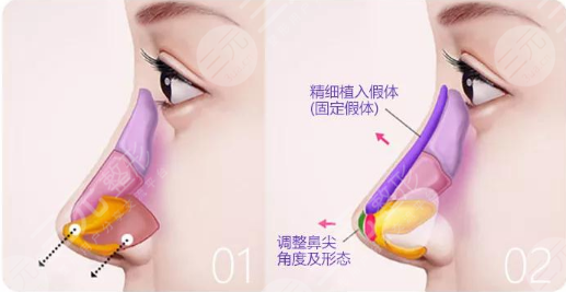 假体隆鼻硅胶好还是膨体好？材料、效果、取出难易度等区别盘点！