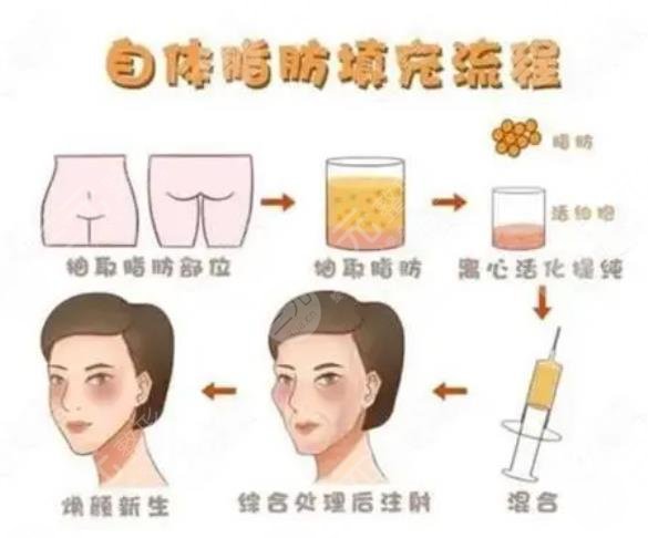 脂肪填充面部