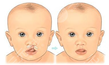 兔唇修复医保报销吗？兔唇修复手术要多少钱隔多久再做？利弊分析