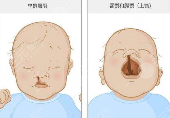 兔唇修复的手术要隔多久再做？