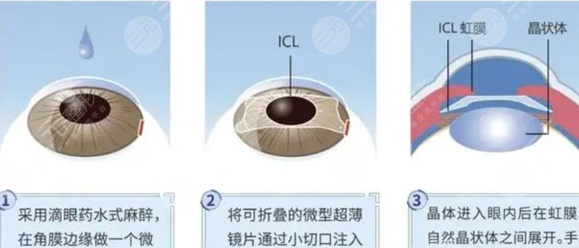 晶片近视手术还会近视么？会复发吗？手术原理与技术优势带你纵览！