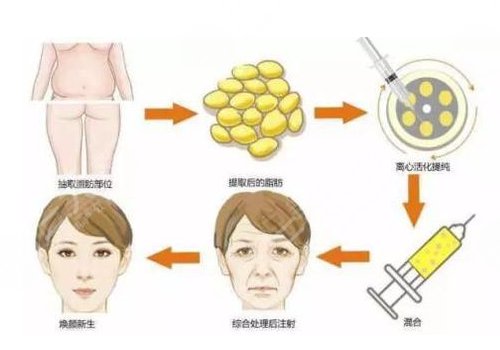 自体脂肪填充