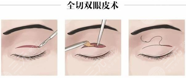 全切双眼皮整形