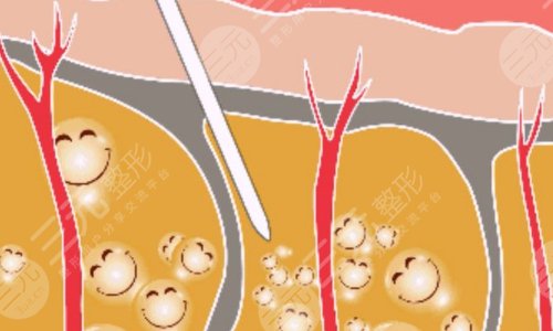 光纤溶脂安全吗？原理、特点、恢复时间盘点！