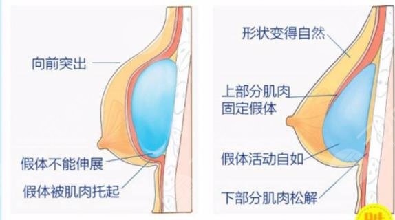 水晶蓝贝假体是国产吗？水晶蓝贝假体隆胸柔软吗？S身材你渴望吗？