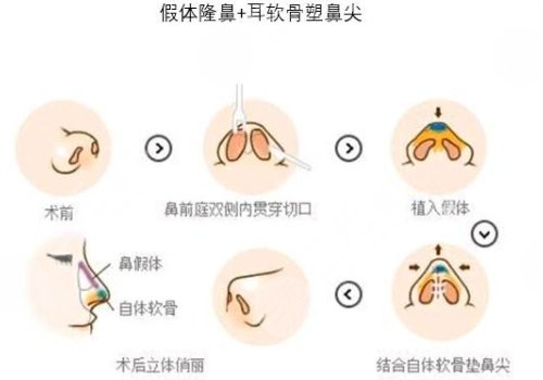 耳软骨隆鼻的恢复期是多久？多少费用？附价格表一览+术后护理技巧