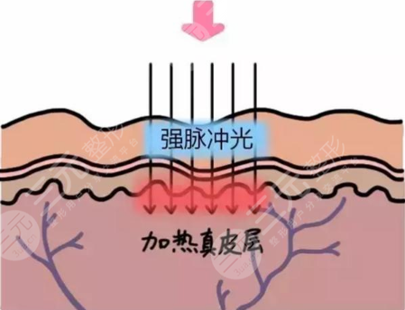 光子嫩肤的原理