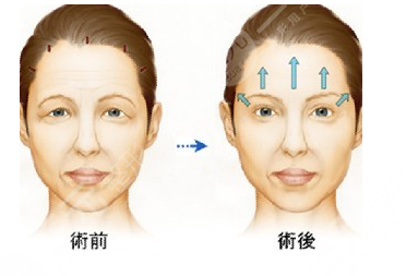 30岁适合做拉皮吗?什么年龄段适合拉皮手术?40+姐姐专属吗?