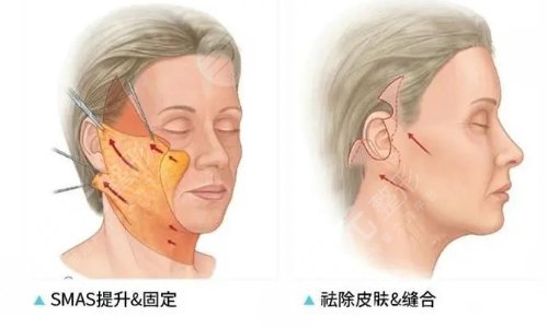 面部拉皮手术能维持几年?可以保持多久?提升果和视频网友分享~