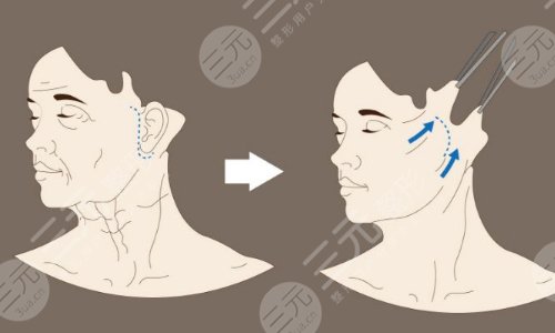 面部拉皮手术能维持几年