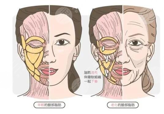 面部拉皮手术案例