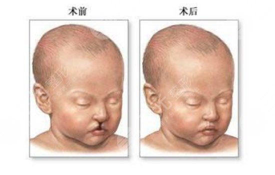 唇腭裂修复手术有哪些注意事项?