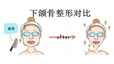 天津德尔美客医疗磨骨案例