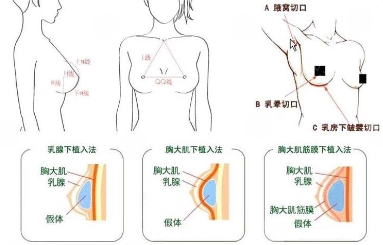 硅胶隆胸原理