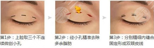 吸雕双眼皮咋做的?术前必看的优势和弊端!美眼超全攻略~