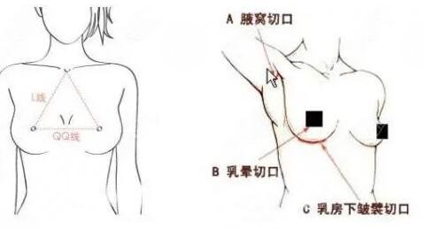 15分钟极速隆胸真人感受