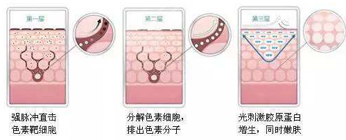激光治疗痘坑凹洞