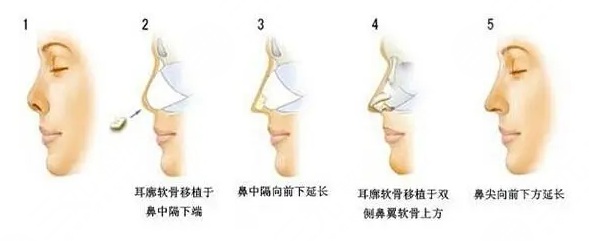 耳软骨隆鼻可以维持多久？多少钱？术前注意事项+术后护理盘点！