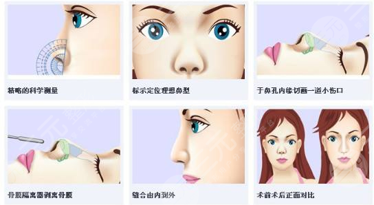 耳软骨隆鼻术前要注意什么?